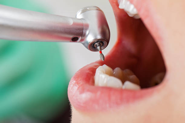 Best Emergency Tooth Extraction in Houston, AK